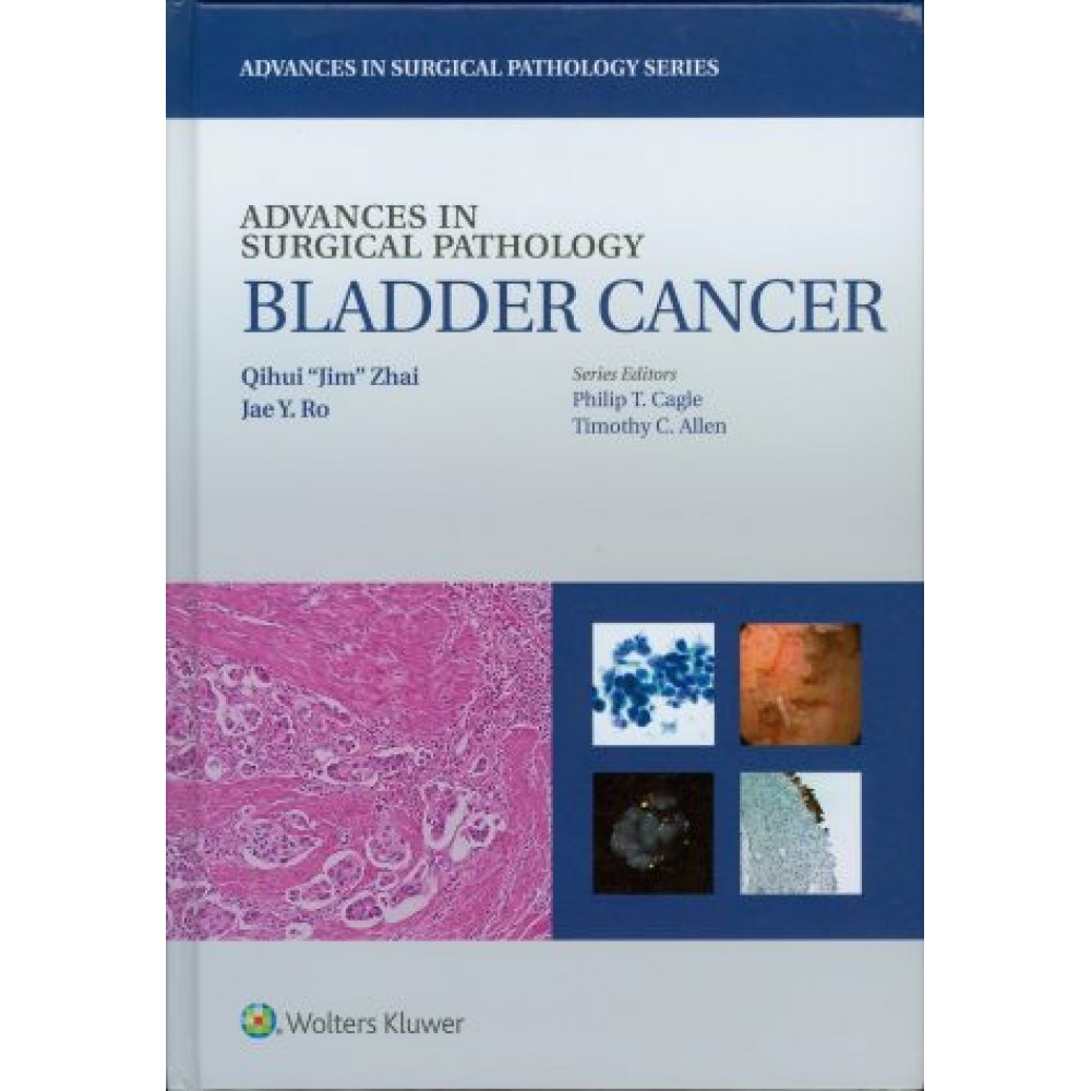 Advances in Surgical Pathology: Bladder Cancer