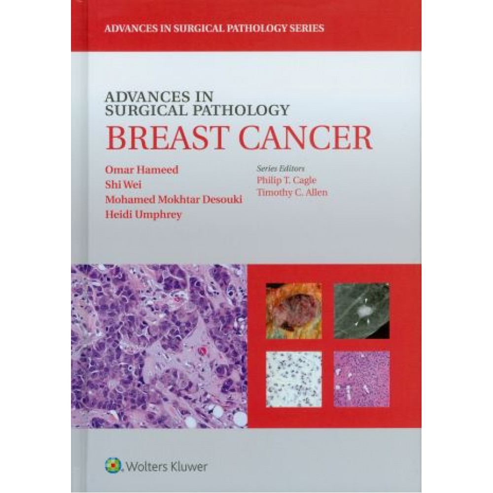 Advances in Surgical Pathology: Breast Cancer