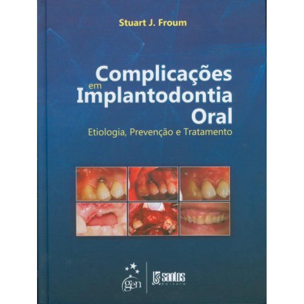Complicações em Implantodontia Oral - Etiologia, Prevenção e Tratamento