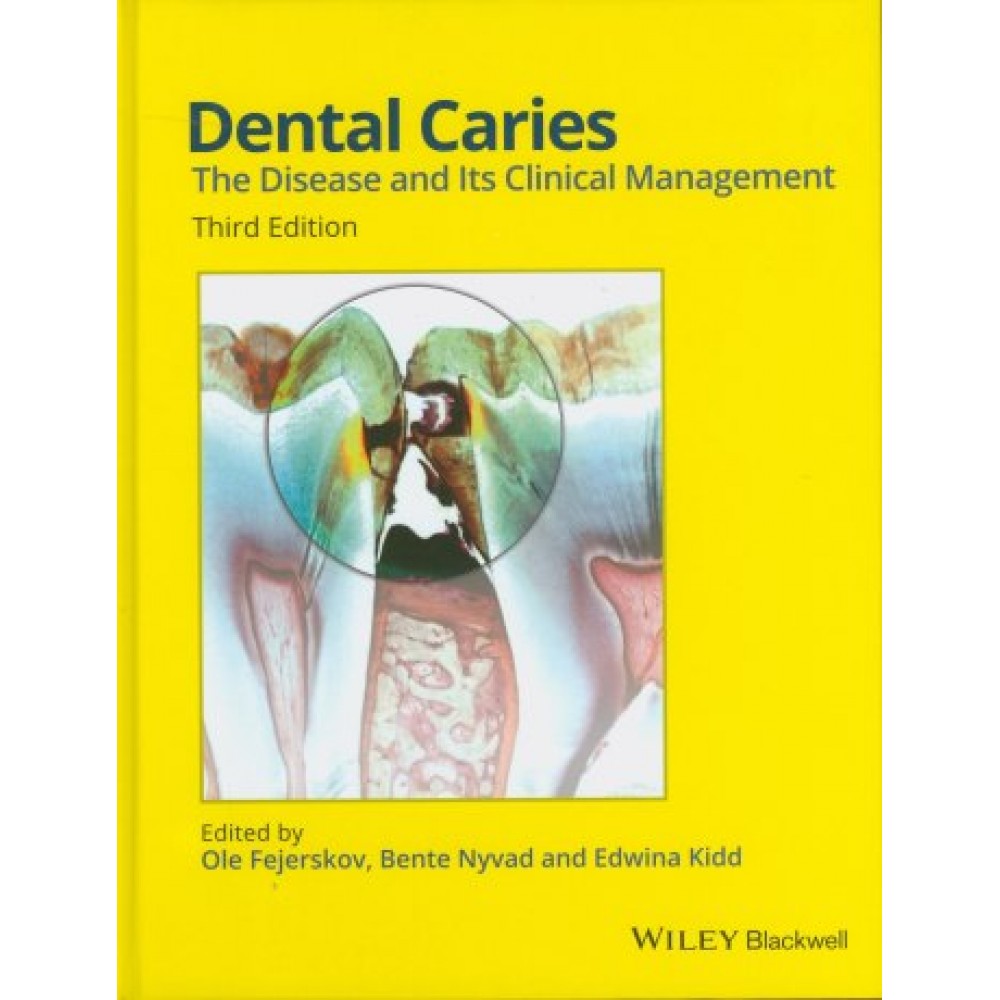 Dental Caries: The Disease and its Clinical Management, 3rd Edition
