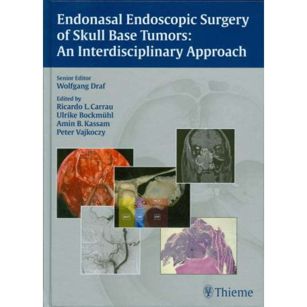 Endonasal Endoscopic Surgery of Skull Base Tumors: An Interdisciplinary Approach