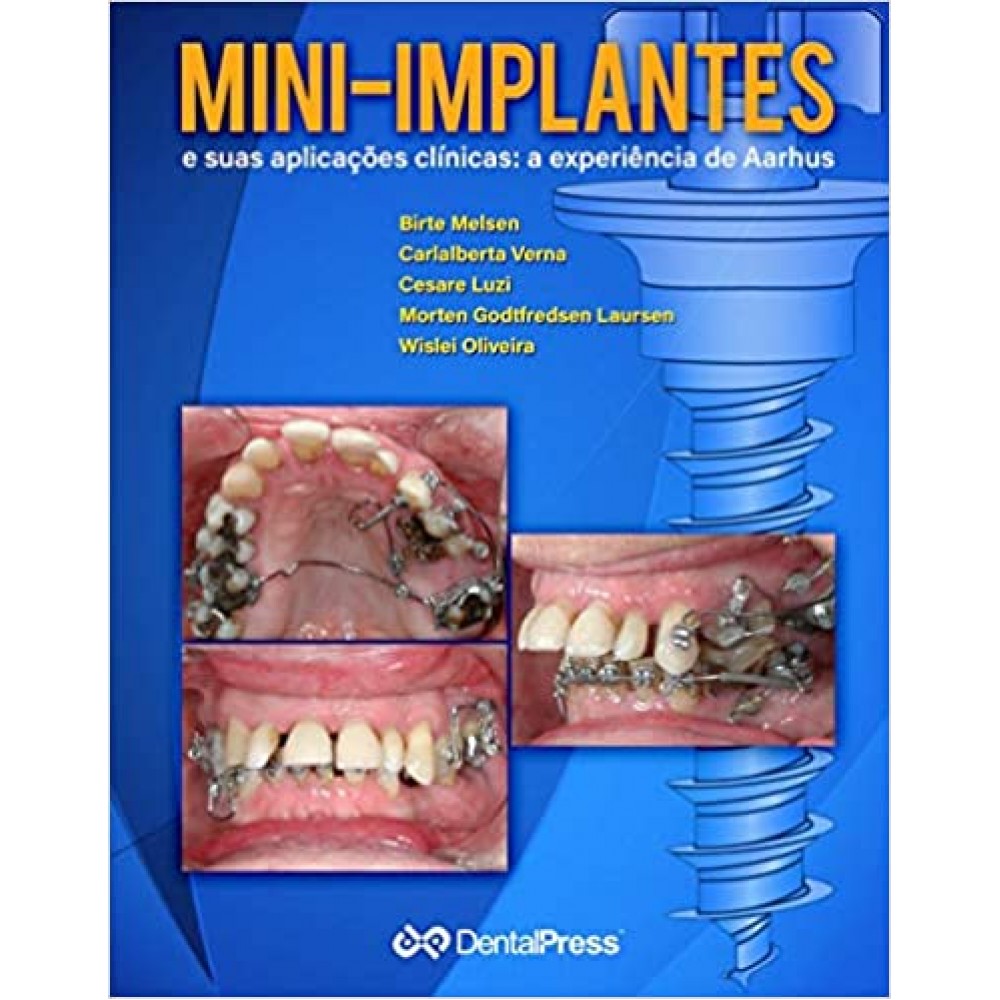 MINI IMPLANTES E SUAS APLICACOES CLINICAS A EXPERIENCIA DE AARHUS
